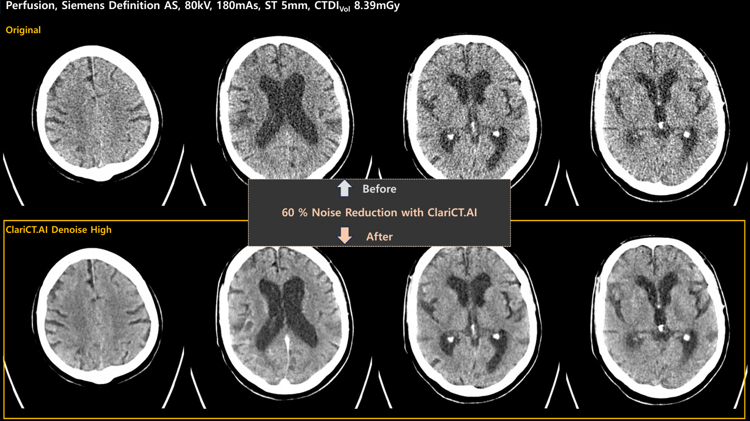 ClariCT.AI reducción de ruido 60% en estudio cerebral