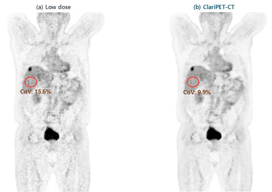Caso clinico de cancer de pulmon procesado con ClariPET·CT