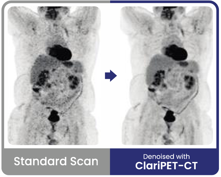 Ejemplo de imagen PET·CT procesada con ClariPET·CT