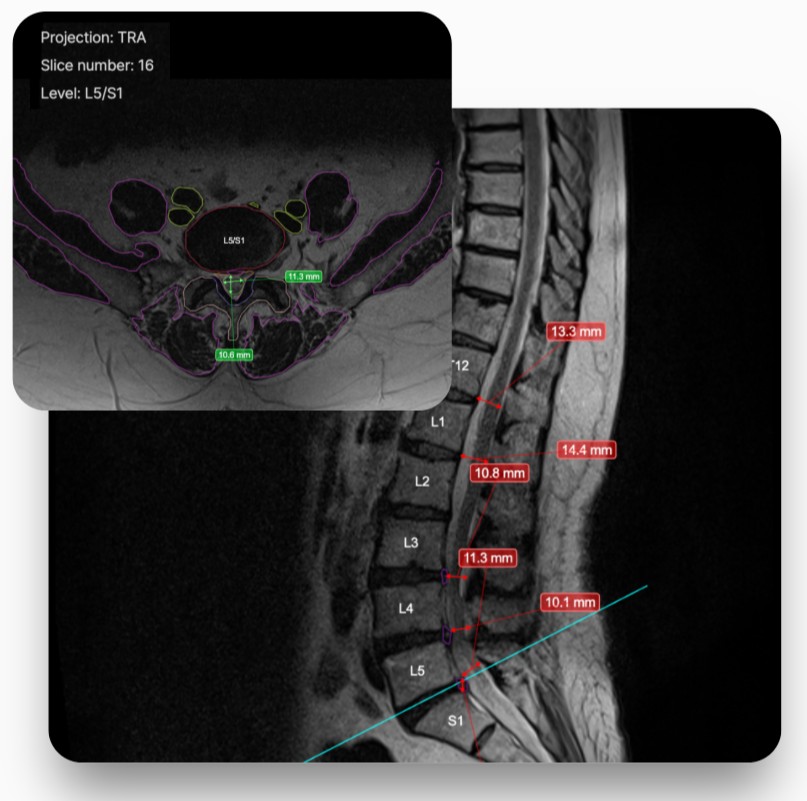 Remedy Logic RAI: etiquetado de niveles vertebrales y segmentacion